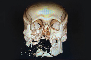 Врачи Минобороны РФ напечатали раненому солдату новое лицо на 3D-принтере 