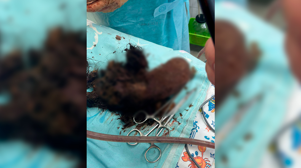 В Сургуте хирурги достали из желудка девочки ком волос длиной 20 см
