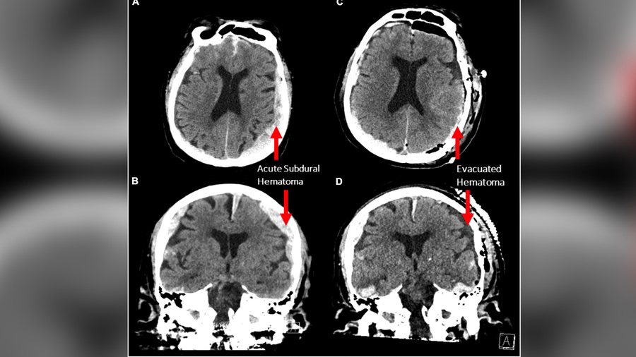 Снимки мозга пациента. Фото © frontiersin.org