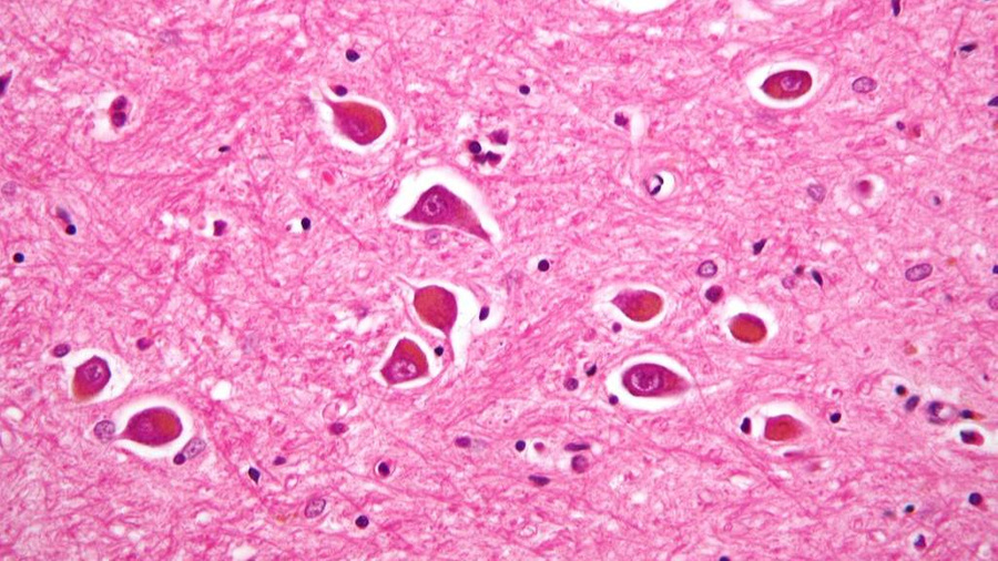 Ткань мозга, поражённого болезнью Альцгеймера, под микроскопом. Фото © Wikimedia Commons / Nephron