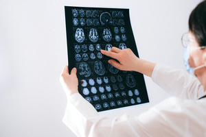 Невролог Чудинская объяснила, как черепно-мозговая травма может повлиять на жизнь