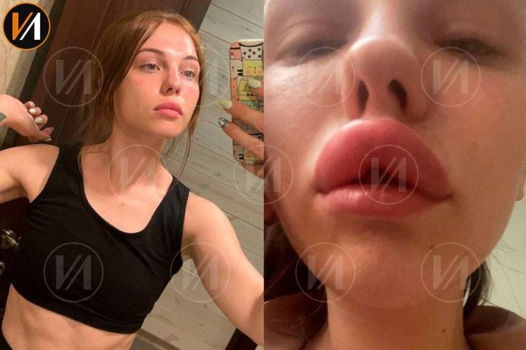 Жительница Новосибирска вместо новых губ получила отёк Квинке, паралич и угрозы