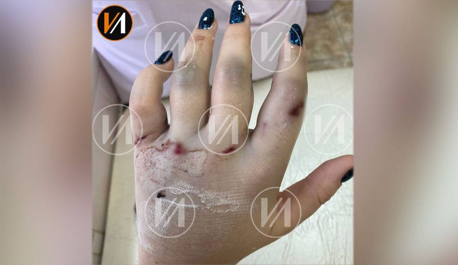 Рука Анастасии после квеста. Фото © Telegram / "Изнанка. Женщины"