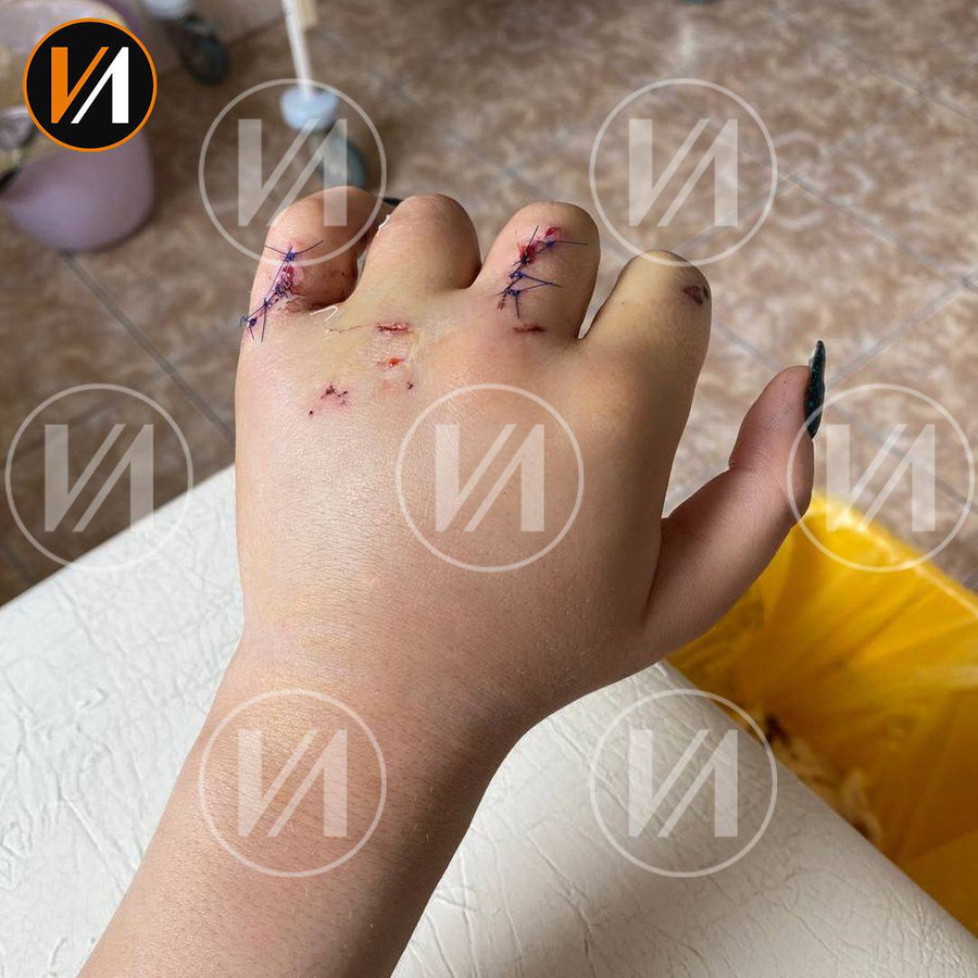 Рука Анастасии после квеста. Фото © Telegram / "Изнанка. Женщины"