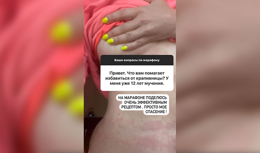 Наташа Королёва с 23 лет страдает крапивницей. Тело звезды то и дело обсыпает красными пятнами. Фото © Instagram (запрещён на территории Российской Федерации) / koroleva__star