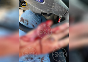 Рука водителя, в которого прилетела металлическая пластина. Фото © Telegram / SHOT
