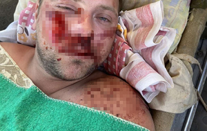"Лежал загорал на пляже": Уралец чудом выжил после того, как по его голове дважды проехал внедорожник