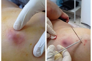 Россиянин пожаловался врачам на боли в ноге, а те достали из неё огромную швейную иглу