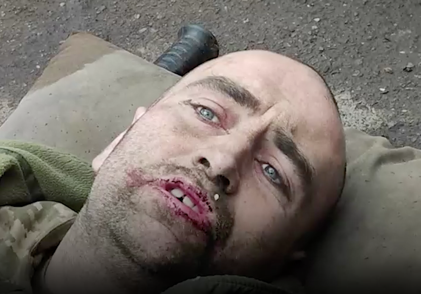 Пытали и бросили при отступлении: Айдаровцы прострелили ноги украинскому призывнику за отказ воевать