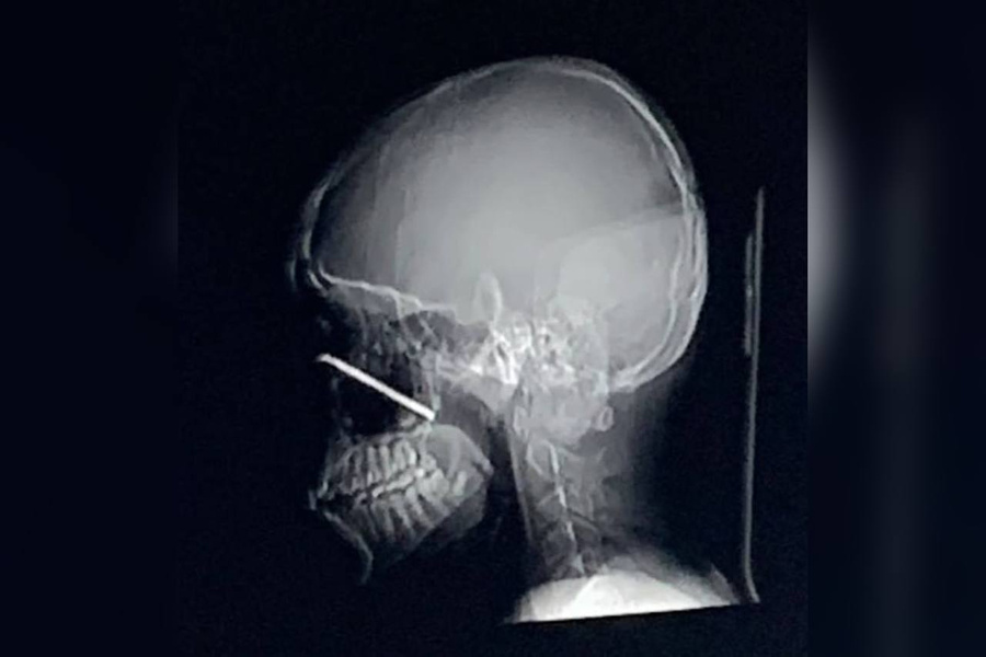 <p>Шестисантиметровый металлический прут отлетел от ворот и попал в глаз ребёнку. Обложка © Фото предоставлено Лайфу</p>