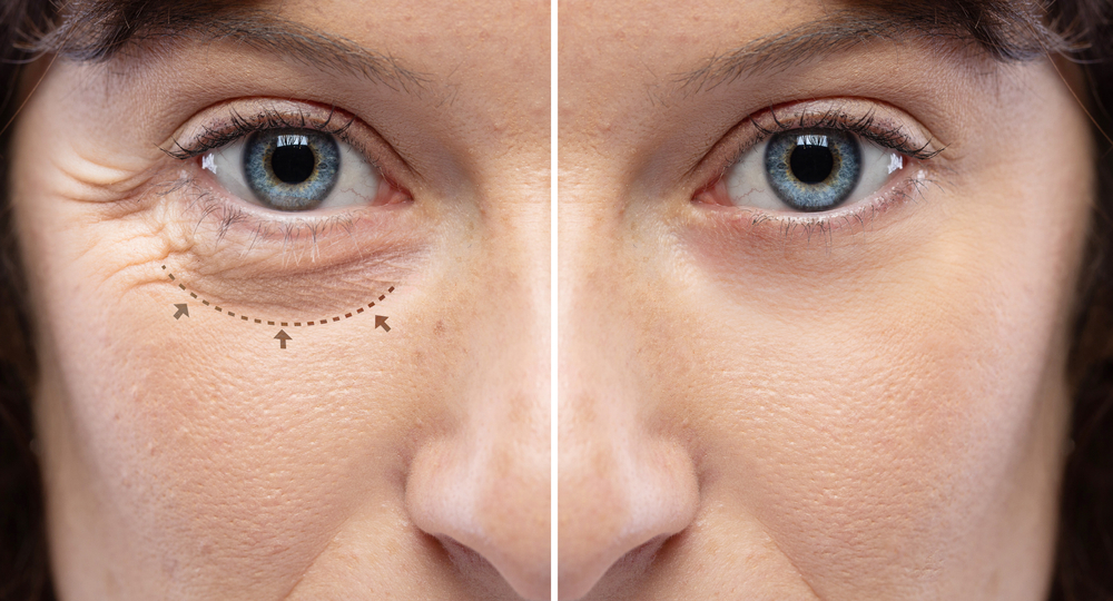 Блефаропластика — это операция по изменению разреза глаз, формы век. Фото © Shutterstock
