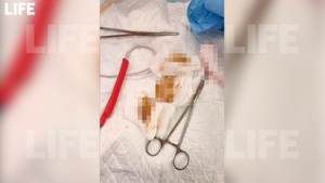 83-летняя россиянка оказалась на столе у хирурга, потому что плохо прожевала курагу