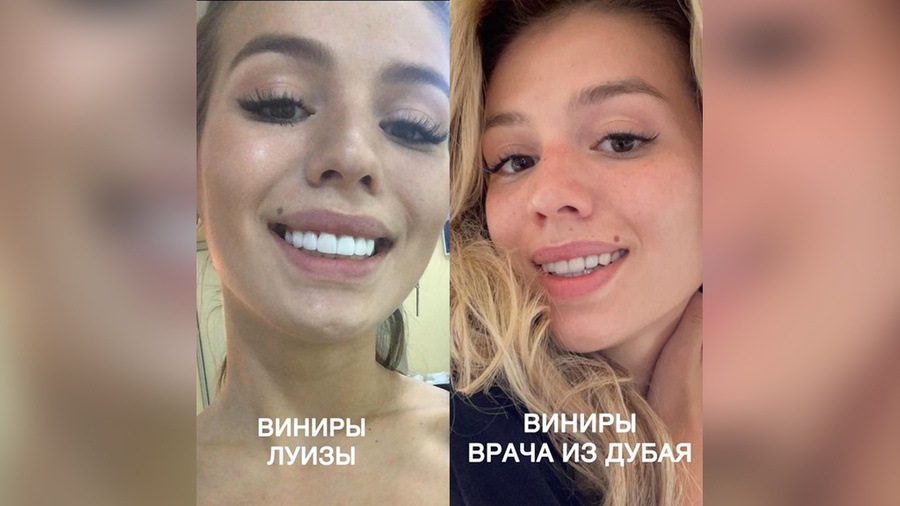 <p>Певица Люся Чеботина показала, как её зубы выглядели после посещения звёздного стоматолога. Работу исправлял врач из ОАЭ. Обложка © Instagram (признан экстремистской организацией и запрещён на территории Российской Федерации) / lusia_chebotina</p>