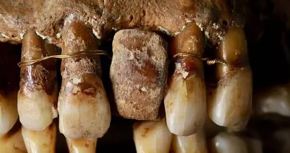 Зубы, скреплённые золотой нитью. Фото © Rozenn Colleter, Inrap / Laval, Mayenne, Pays de la Loire