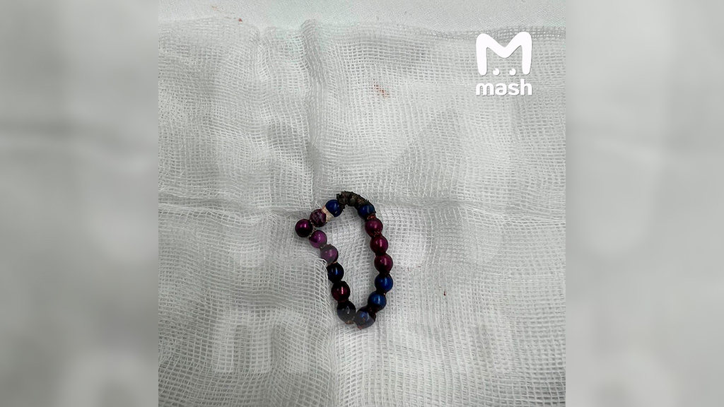 15 слипшихся магнитов, которые врачи достали из живота маленького ребёнка. Фото © t.me / Mash