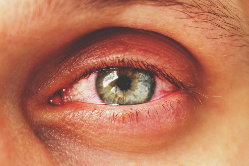 Глаз с участком отслоившейся сетчатки. Фото © Shutterstock