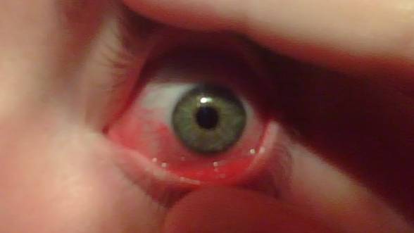 Конъюнктивит — воспаление слизистой оболочки глаза. Фото © Flickr / XenaDance