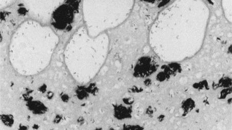 Язва Бурули под микроскопом. Изображение © The Lancet