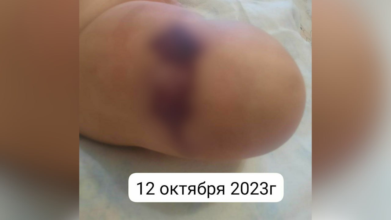 Изменения на коже мальчика из Якутска. Фото © VK / "КримЯкутия"