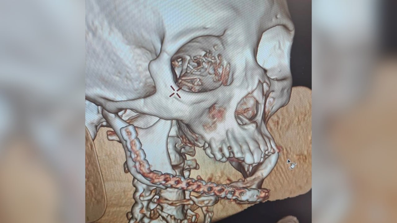 Нижняя часть челюсти пациентки отмерла из-за остеомиелита. Фото © VK / Управление здравоохранения по г. Набережные Челны