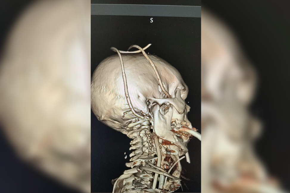 Зубцы вошли на 11 см: Сибирские врачи спасли мужчину, которому проткнули голову вилами