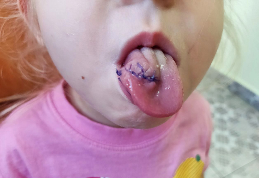 В Иркутске врачи зашили девочке язык, который был порван после падения. Фото © t.me / Ивано-Матрёнинская детская клиническая больница