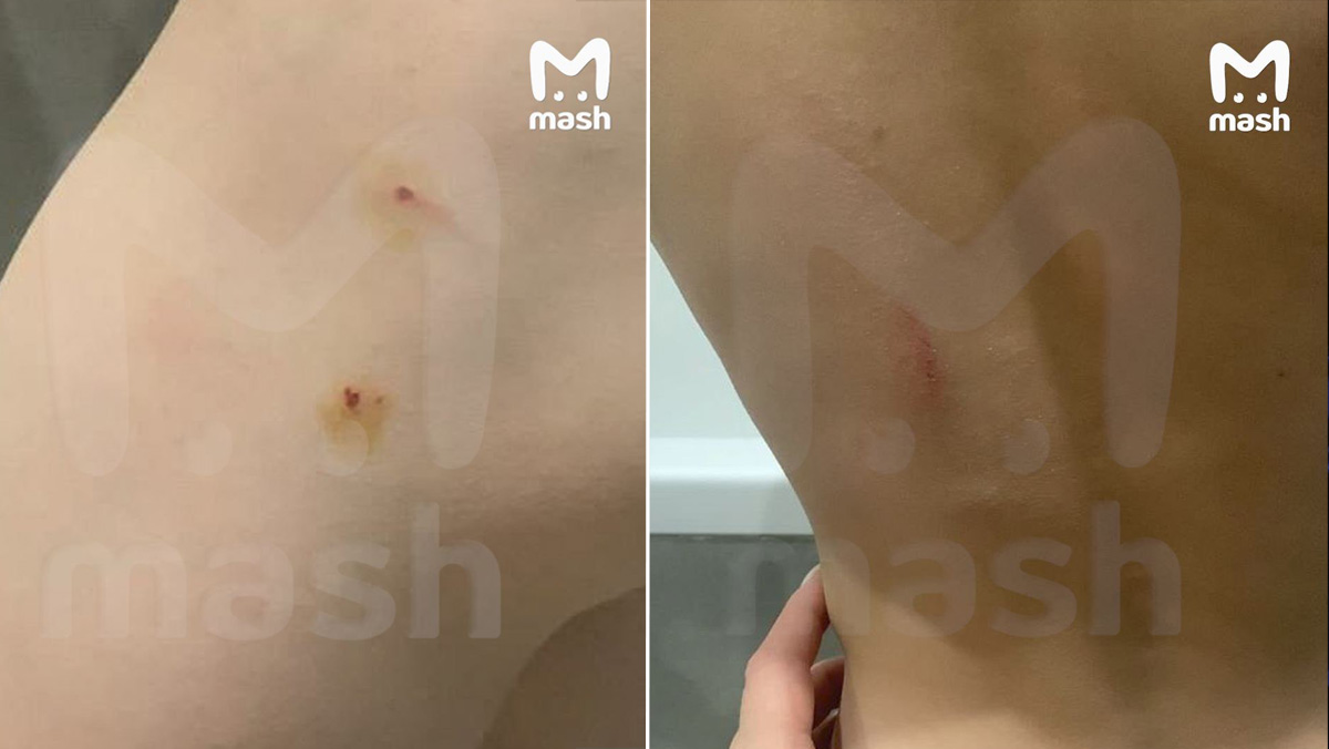 Последствия удара карандашом ребёнка в подмосковном детсаду. Обложка © Telegram / Mash