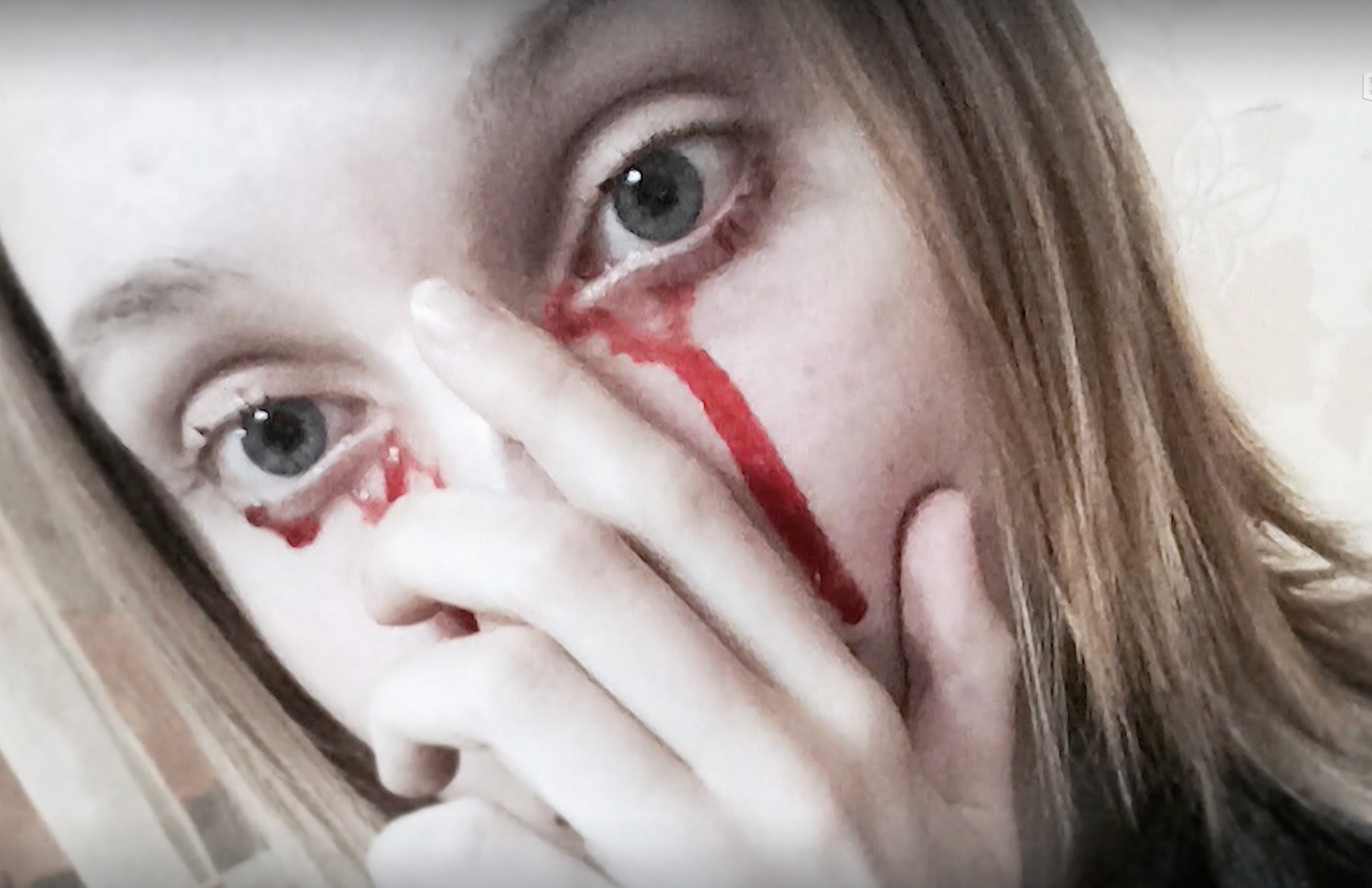 На фотографии видно, что "кровь" под правым глазом девушки, похоже, не вытекала из слёзного канала, а выглядит так, будто была нанесена искусственно. Фото © smotrim.ru / Программа "Малахов"