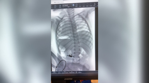Рентген малыша, проглотившего связку ключей. Фото © VK / ЧОДКБ