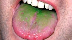 Скажите "а": 7 опасных симптомов, которые можно обнаружить во рту