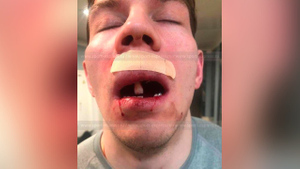 Хирург объяснил, как плечо хоккеиста Радулова "выбило" Зыкову верхние зубы