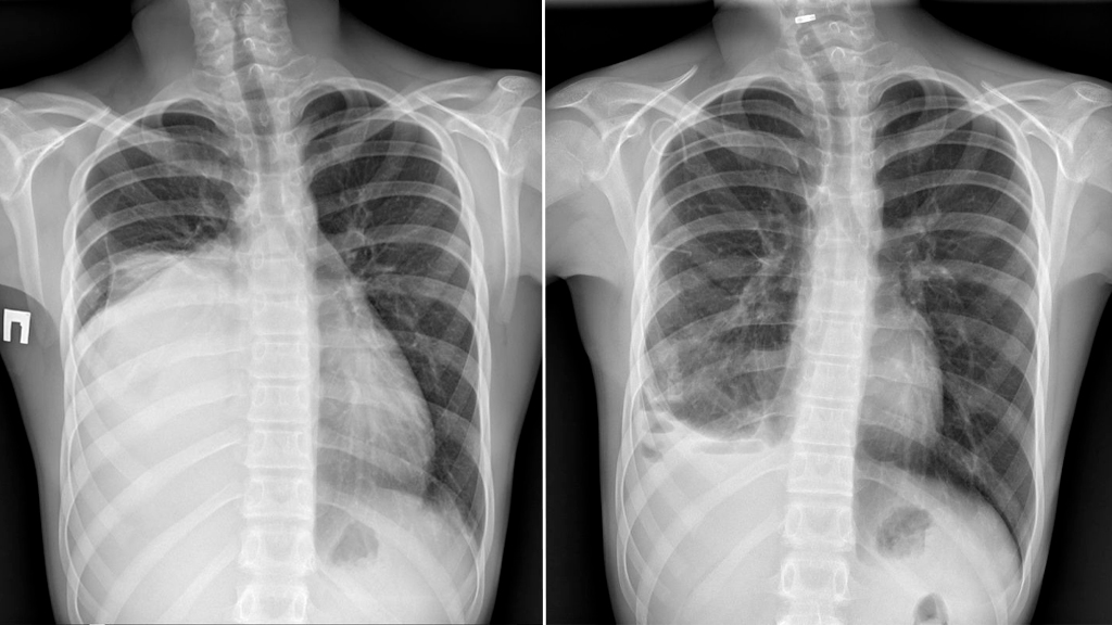 Рентген грудной полости ребёнка до и после лечения. Фото © VK / Российская детская клиническая больница (РДКБ)