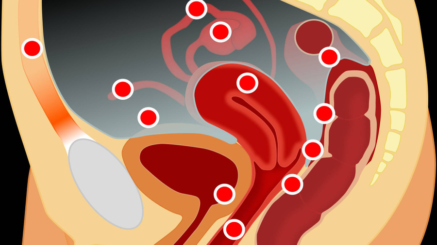 Красными точками обозначены зоны возникновения эндометриоза. Изображение © Wikimedia Commons / Hic et nunc