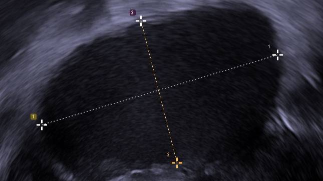 На УЗИ эндометриоз выглядит как тёмное зернистое пятно. Изображение © Wikimedia Commons / Mikael Häggström