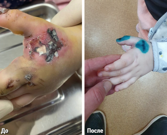 Врачи диагностировали у малышки перелом пальца и ушиб мягких тканей. Фото © Минздрав Московской области 