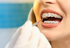 Не только кривые зубы: Какие проблемы можно исправить брекетами и элайнерами