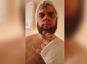 Выбили зуб, сломали руку и челюсть: Экс-кандидата в депутаты Госдумы жестоко избили прямо у дома
