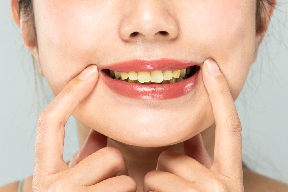 Стоматолог объяснила, от чего на зубах появляется желтизна