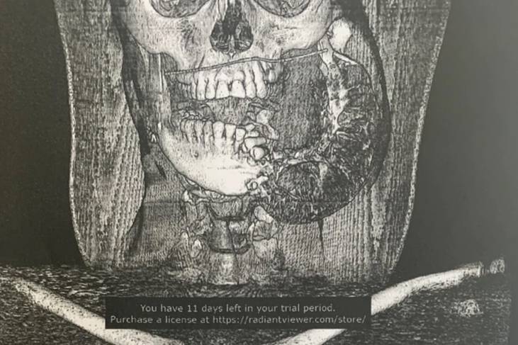 Снимок до операции. Фото © kp.ru, медицинский центр ДВФУ