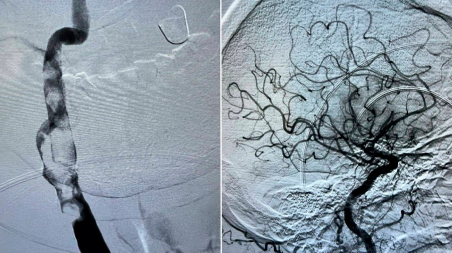 Снимок сосуда до операции (слева) и после (справа). Фото © Минздрав Московской области