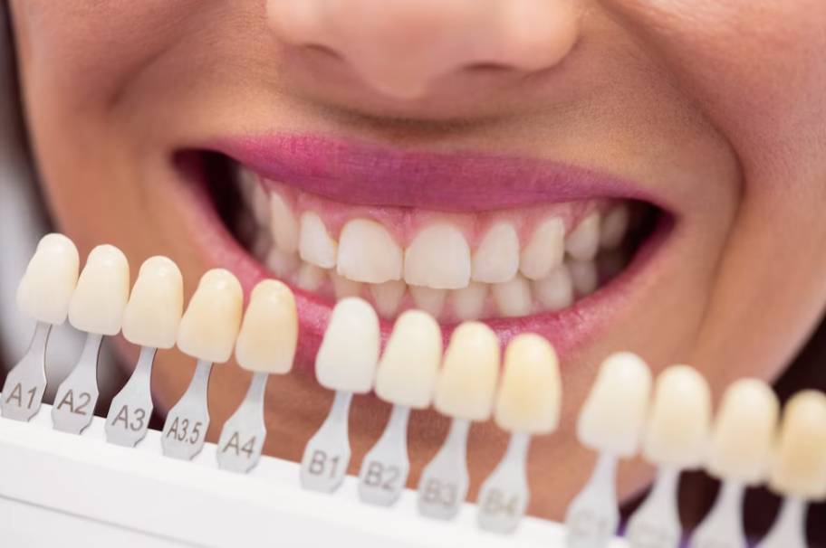 Стоматолог рассказала, какие процедуры нужно пройти перед отбеливанием зубов