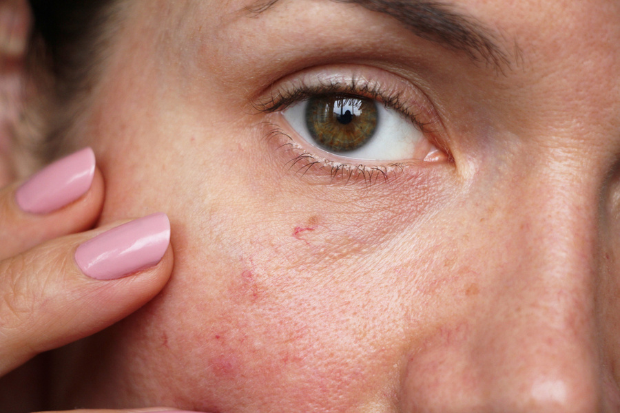 Сосудистые звёздочки на лице и теле можно удалять. Фото © Shutterstock