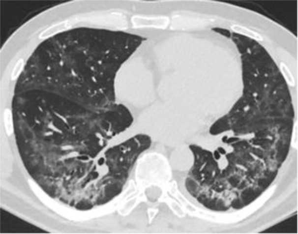Лёгкие пациента после ксеноновой терапии. Фото © National Library of Medicine 