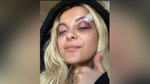 Певице Биби Рексе наложили швы после нападения поклонника на концерте