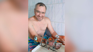 Омские врачи "по кусочкам" собрали мужчине руку, которую он отрезал циркулярной пилой 