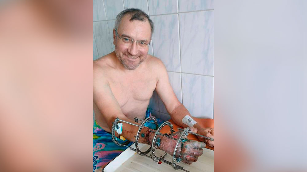 Омские врачи "по кусочкам" собрали мужчине руку, которую он отрезал циркулярной пилой 