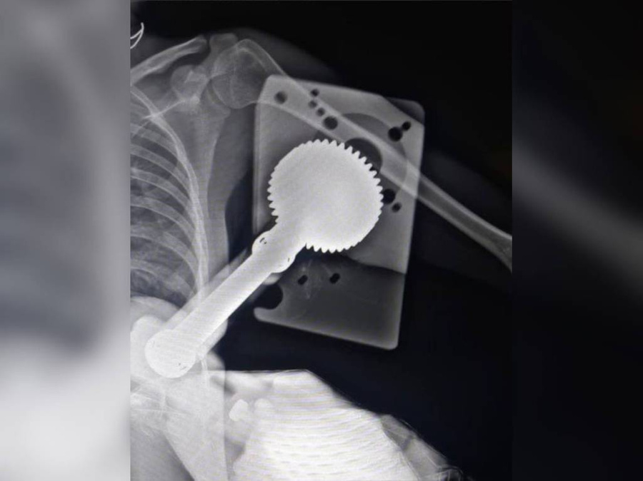 Рентген-снимок с местом повреждения в руке девушки в результате работы с зернодробильной машиной. Фото © Каширская больница