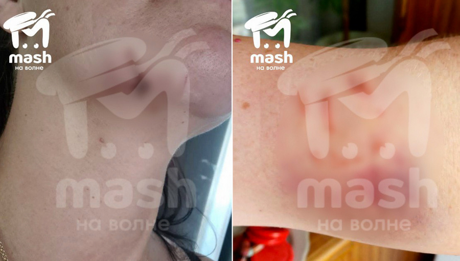 Две пострадавшие женщины с укусами неизвестного мужчины в Бахчисарае. Фото © T.me / Mash