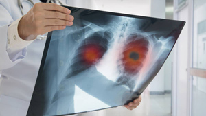 Кашель, температура и не только: Онколог перечислил первые симптомы рака лёгких