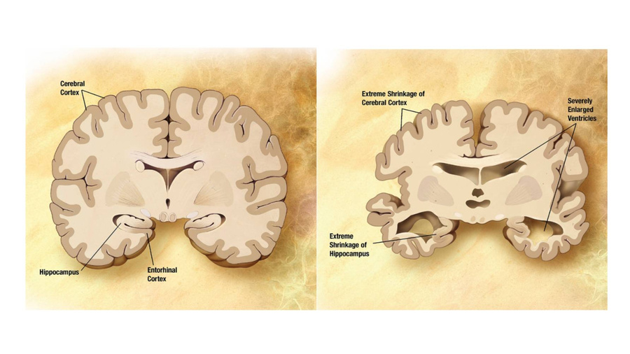 Слева — нормальный  мозг, справа — поражённый болезнью Альцгеймера. Изображение © Wikimedia Commons / Alzheimer's Disease Education and Referral Center